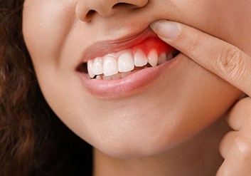 Woman lifting lip to reveal inflamed gums