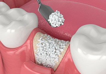 Illustration of granular bone material being placed in tooth socket during bone graft surgery