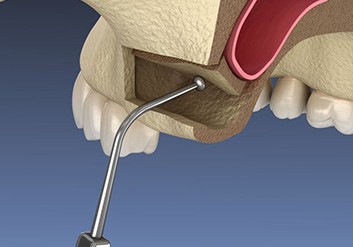 Illustration of instrument being used to lift sinus membrane