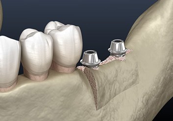 Illustration of implants in jawbone after ridge augmentation