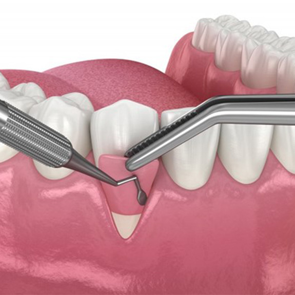 a 3D depiction of gum grafting for an exposed tooth