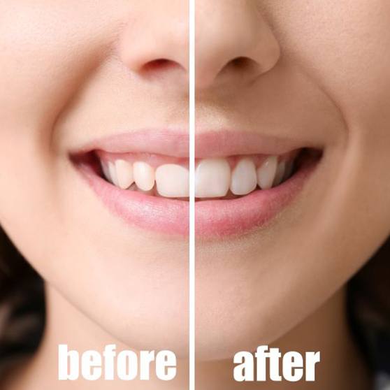 Close-up of woman’s smile before and after gummy smile correction